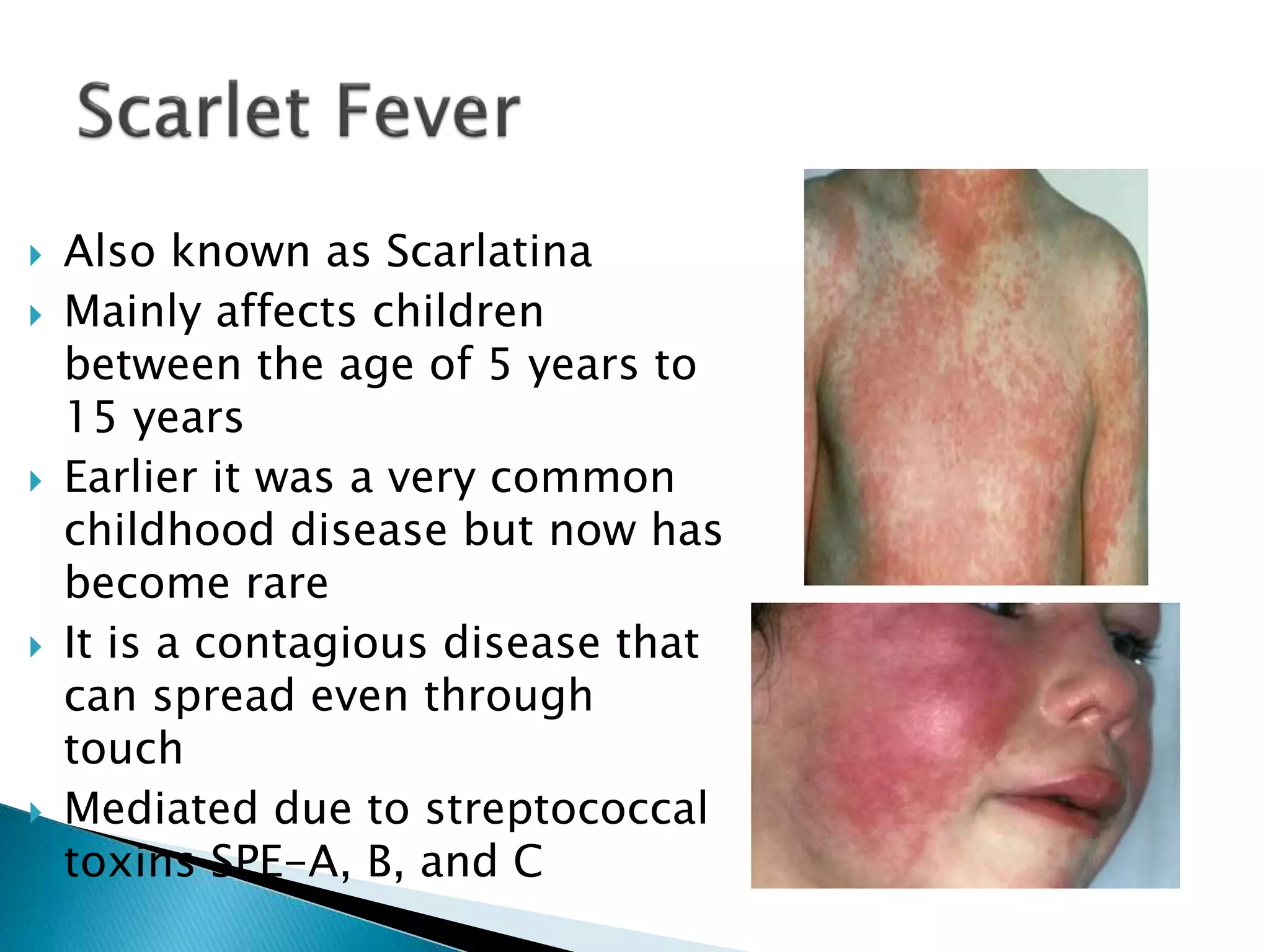  Also known as Scarlatina
 Mainly affects children
between the age of 5 years to
15 years
 Earlier it was a very common
childhood disease but now has
become rare
 It is a contagious disease that
can spread even through
touch
 Mediated due to streptococcal
toxins SPE-A, B, and C
 