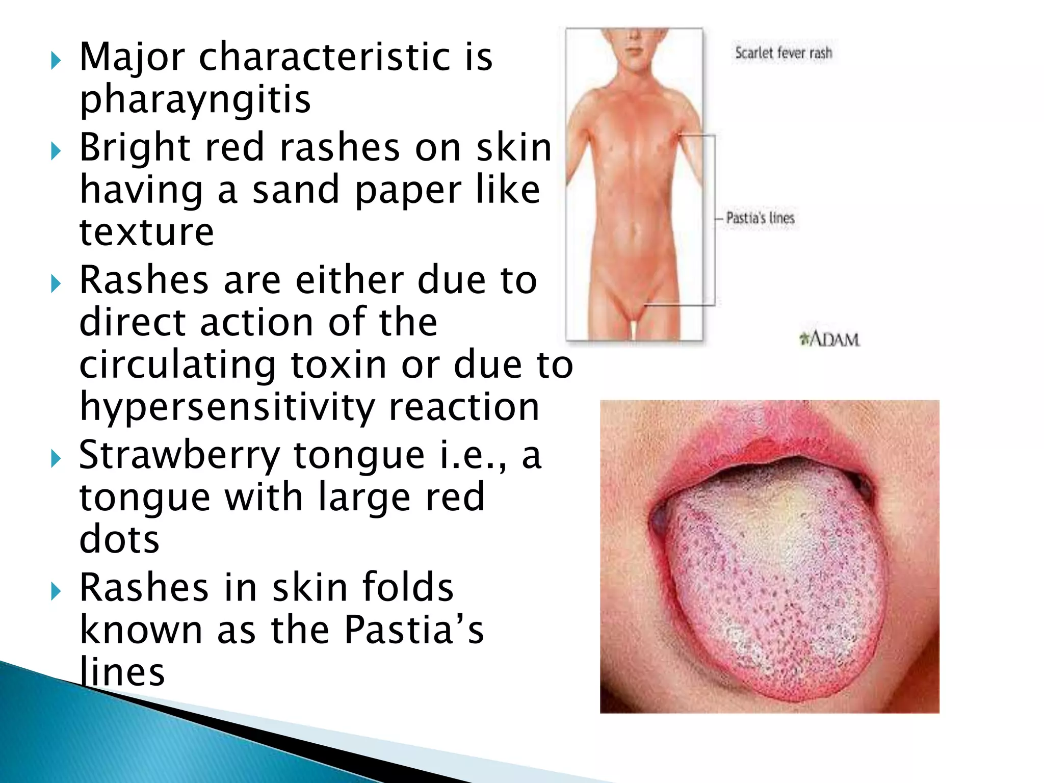  Major characteristic is
pharayngitis
 Bright red rashes on skin
having a sand paper like
texture
 Rashes are either due to
direct action of the
circulating toxin or due to
hypersensitivity reaction
 Strawberry tongue i.e., a
tongue with large red
dots
 Rashes in skin folds
known as the Pastia’s
lines
 