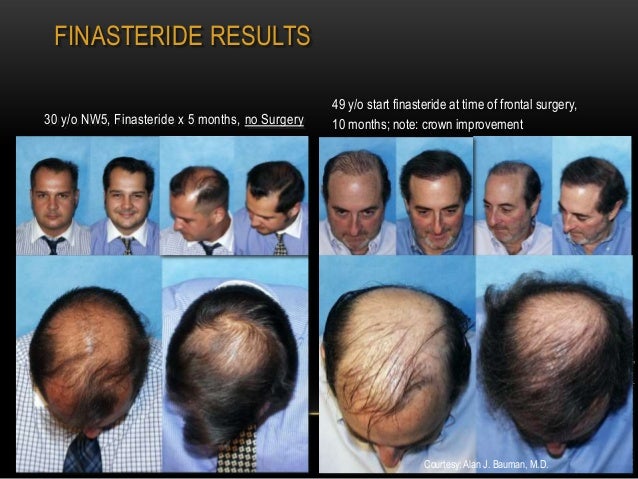 5mg day finasteride every other