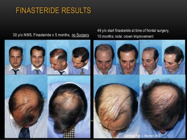 can rogaine cause more hair loss