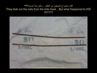 ‫اصابه؟؟؟؟‬ ‫مانذا‬ ‫ولكن‬ .. ‫الطفل‬ ‫من‬ ‫السيخين‬ ‫استخراج‬ ‫!!تم‬
They took out the rods from the kids head .. But what Happened to KID
!!!!????
 