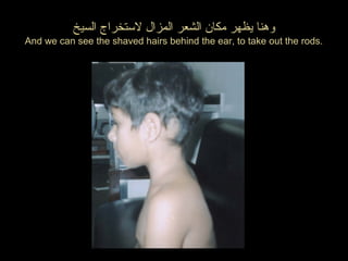 ‫السيخ‬ ‫لستخراج‬ ‫المزال‬ ‫الشعر‬ ‫مكان‬ ‫يظهر‬ ‫وهنا‬
And we can see the shaved hairs behind the ear, to take out the rods.
 