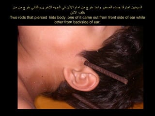 ‫من‬ ‫من‬ ‫رخرج‬ ‫والثاني‬ ‫الرخرى‬ ‫الجهه‬ ‫في‬ ‫النذن‬ ‫امام‬ ‫من‬ ‫رخرج‬ ‫واحد‬ ‫الصغير‬ ‫جسده‬ ‫ارخترقا‬ ‫السيخين‬
‫النذن‬ ‫رخلف‬
Two rods that pierced kids body ,one of it came out from front side of ear while
other from backside of ear.
 