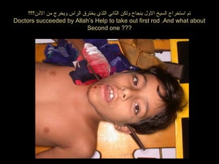 ‫النذن؟؟؟‬ ‫من‬ ‫ويخرج‬ ‫الراس‬ ‫يخترق‬ ‫اللذي‬ ‫الثاني‬ ‫ولكن‬ ‫بنجاح‬ ‫الول‬ ‫السيخ‬ ‫استخراج‬ ‫تم‬
Doctors succeeded by Allah’s Help to take out first rod .And what about
Second one ???
 
