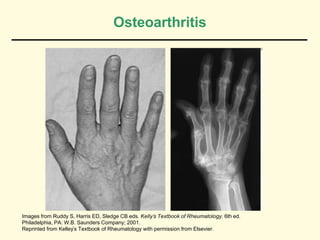 Osteoarthritis




Images from Ruddy S, Harris ED, Sledge CB eds. Kelly’s Textbook of Rheumatology. 6th ed.
Philadelphia, PA: W.B. Saunders Company; 2001.
Reprinted from Kelley’s Textbook of Rheumatology with permission from Elsevier.