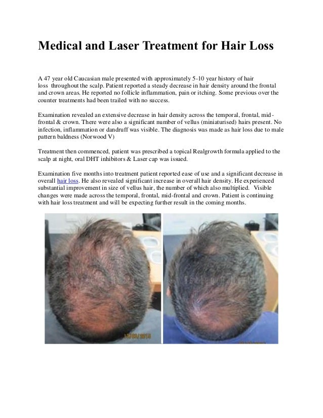 Medical And Laser Treatment For Hair Loss