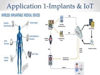 Application 1-Implants & IoT
 