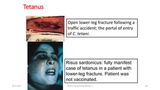 Tetanus
Open lower-leg fracture following a
traffic accident; the portal of entry
of C. tetani.
Risus sardonicus: fully manifest
case of tetanus in a patient with
lower-leg fracture. Patient was
not vaccinated.
8/11/2023 Medical Bacteriology Module 2 100
 