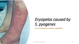 Erysipelas caused by
S. pyogenes
8/11/2023 Medical Bacteriology Module 2 38
 