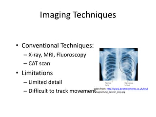 Imaging Techniques
• Conventional Techniques:
– X-ray, MRI, Fluoroscopy
– CAT scan
• Limitations
– Limited detail
– Difficult to track movement
Taken from: http://www.besttreatments.co.uk/btuk
/images/lung_cancer_xray.jpg
 