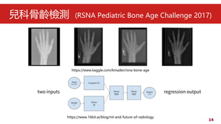 14
ƹgzy (RSNA Pediatric Bone Age Challenge 2017)
https://www.kaggle.com/kmader/rsna-bone-age
https://www.16bit.ai/blog/ml-and-future-of-radiology
two inputs regression output
 