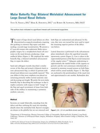 Malar Butterfly Flap: Bilateral Melolabial Advancement for
Large Dorsal Nasal Defects
TONY N. NAKHLA, DO,Ã MARK K. HOROWITZ, DO,Ã                           AND   ROBERT M. SCHWARTZ, MD, FACSy


The authors have indicated no significant interest with commercial supporters.




T     he repair of large dorsal nasal defects are often
      characterized as surgical conundrums, requiring
skin grafting or extensive flap repair and often
                                                                  both flaps are undermined and advanced. In this
                                                                  case, they were not excised but were used to repair
                                                                  the remaining superior portion of the defect
needing a second stage reconstruction. We present a               (see below).
67-year-old woman who underwent Mohs micro-
graphic surgery for a morpheaform basal cell carci-               Lateral dissection is performed in the subcutaneous
noma on the nasal dorsum, producing a large                       plane immediately above the superficial muscular
midfacial defect (Figure 1). We employed the malar                aponeurotic system (Figure 2). Care is taken in the
butterfly flap, a bilateral melolabial advancement                superomedial portion of the flap to avoid transection
flap, to repair the defect.                                       of the angular artery.2,3 Adequate undermining to
                                                                  approximately the medial border of the zygoma su-
Sand and colleagues recently described a similar                  periorly and the oral commissure inferolaterally is
review of this flap and termed it bilateral cheek to              essential to minimize wound tension on both flaps,
nose advancement flap, in which 12 patients with                  which will be joined medially (Figure 3). The flaps
dorsal nasal defects were successfully repaired.1 This            are anchored to the perichondrium of the nasal root
case differs in that more emphasis was placed on                  and approximated to one another. Redundant skin
remaining primarily within normal anatomic sulci
and decreasing scar length. We prefer the term malar
butterfly flap in describing this technique in that it
implies symmetry with respect to both ‘‘wings’’ of
the flap and equal recruitment of tissue from both
sides of the midface in maintaining a symmetric
aesthetic outcome.



Method

Incisions are made bilaterally, extending from the
defect and then outlining the nasal ala extending
distally down the melolabial fold. Burow’s triangles
are drawn in the glabella but are not removed until               Figure 1. 2.8- Â 3.1-cm post-Mohs dorsal nasal defect.

ÃDepartment of Dermatology, Western University College of Osteopathic Medicine/Pacific Hospital, Long Beach,
California; yDivision of Orbitofacial Plastic Surgery, Montefiore Hospital, Albert Einsten College of Medicine, New
York, NY

& 2009 by the American Society for Dermatologic Surgery, Inc.  Published by Wiley Periodicals, Inc. 
ISSN: 1076-0512  Dermatol Surg 2009;35:253–256  DOI: 10.1111/j.1524-4725.2008.34418.x

                                                                                                                           253
 