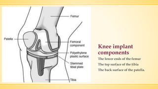 Knee implant
components
The lower ends of the femur
The top surface of the tibia
The back surface of the patella.
 