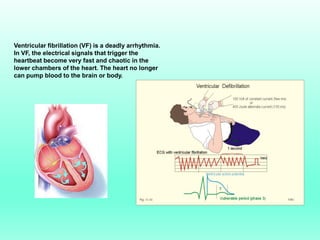 Ventricular fibrillation (VF) is a deadly arrhythmia.
In VF, the electrical signals that trigger the
heartbeat become very fast and chaotic in the
lower chambers of the heart. The heart no longer
can pump blood to the brain or body.
 