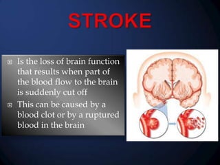



Is the loss of brain function
that results when part of
the blood flow to the brain
is suddenly cut off
This can be caused by a
blood clot or by a ruptured
blood in the brain

 