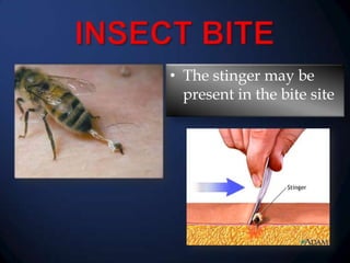 • The stinger may be
present in the bite site

 