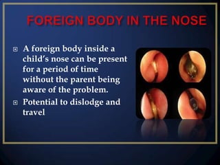



A foreign body inside a
child’s nose can be present
for a period of time
without the parent being
aware of the problem.
Potential to dislodge and
travel

 