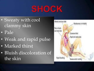 • Sweaty with cool
clammy skin
• Pale
• Weak and rapid pulse
• Marked thirst
• Bluish discoloration of
the skin

 
