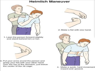 Heimlich maneuver
42
 