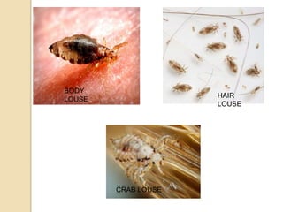 BODY
LOUSE
HAIR
LOUSE
CRAB LOUSE
 