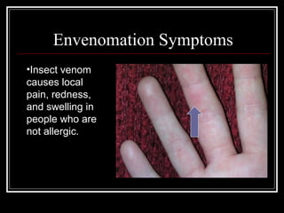 •Insect venom
causes local
pain, redness,
and swelling in
people who are
not allergic.
Envenomation Symptoms
 