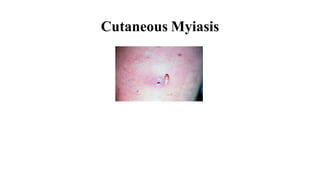 Cutaneous Myiasis
 