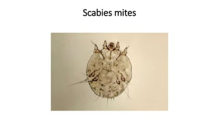 Scabies mites
 