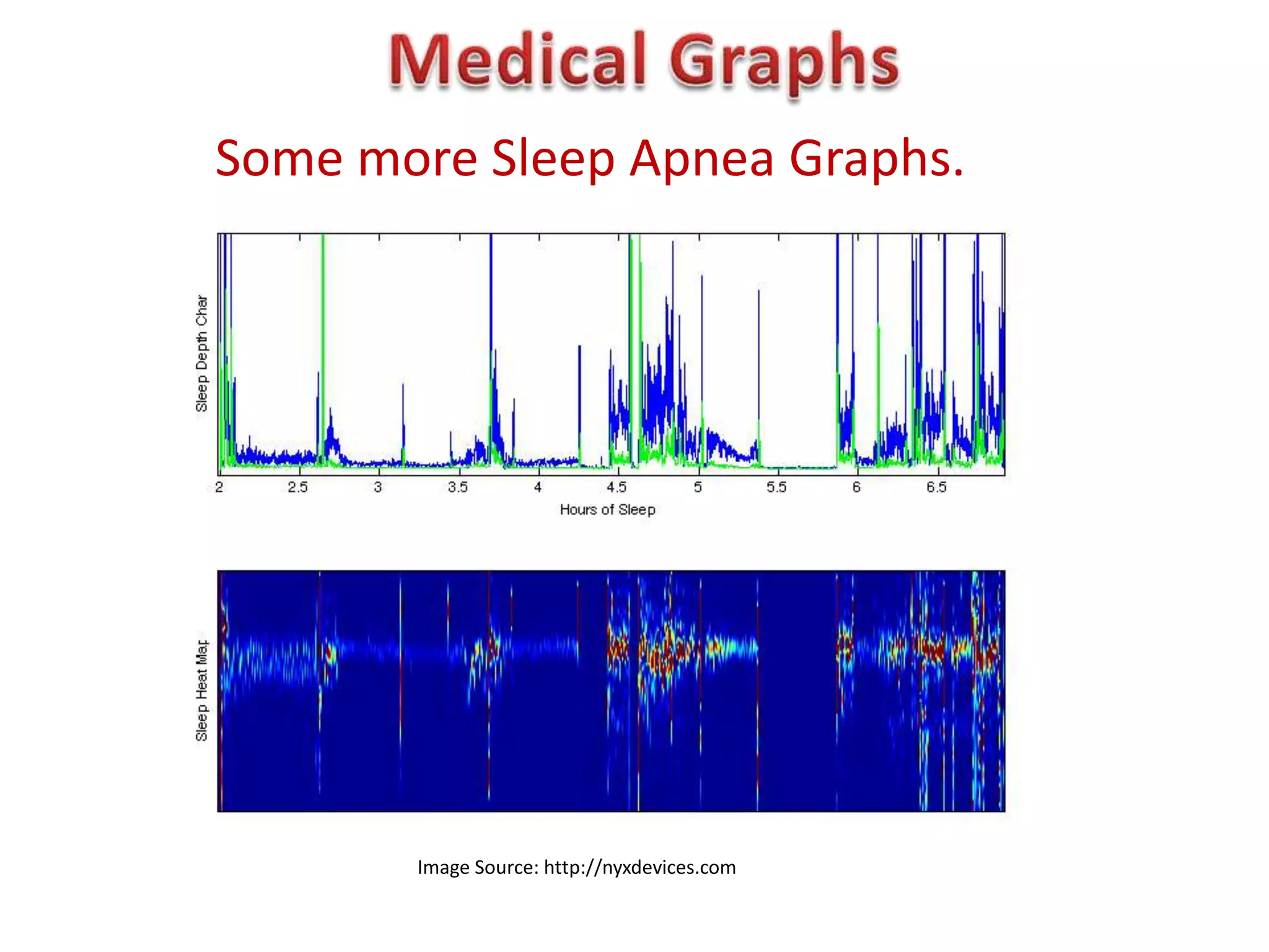 Some more Sleep Apnea Graphs.




       Image Source: http://nyxdevices.com
 