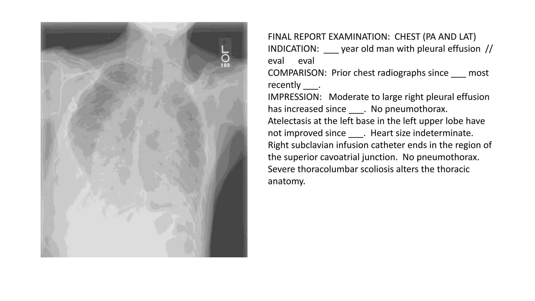 Medical Image Captioning of chest x-ray.pptx