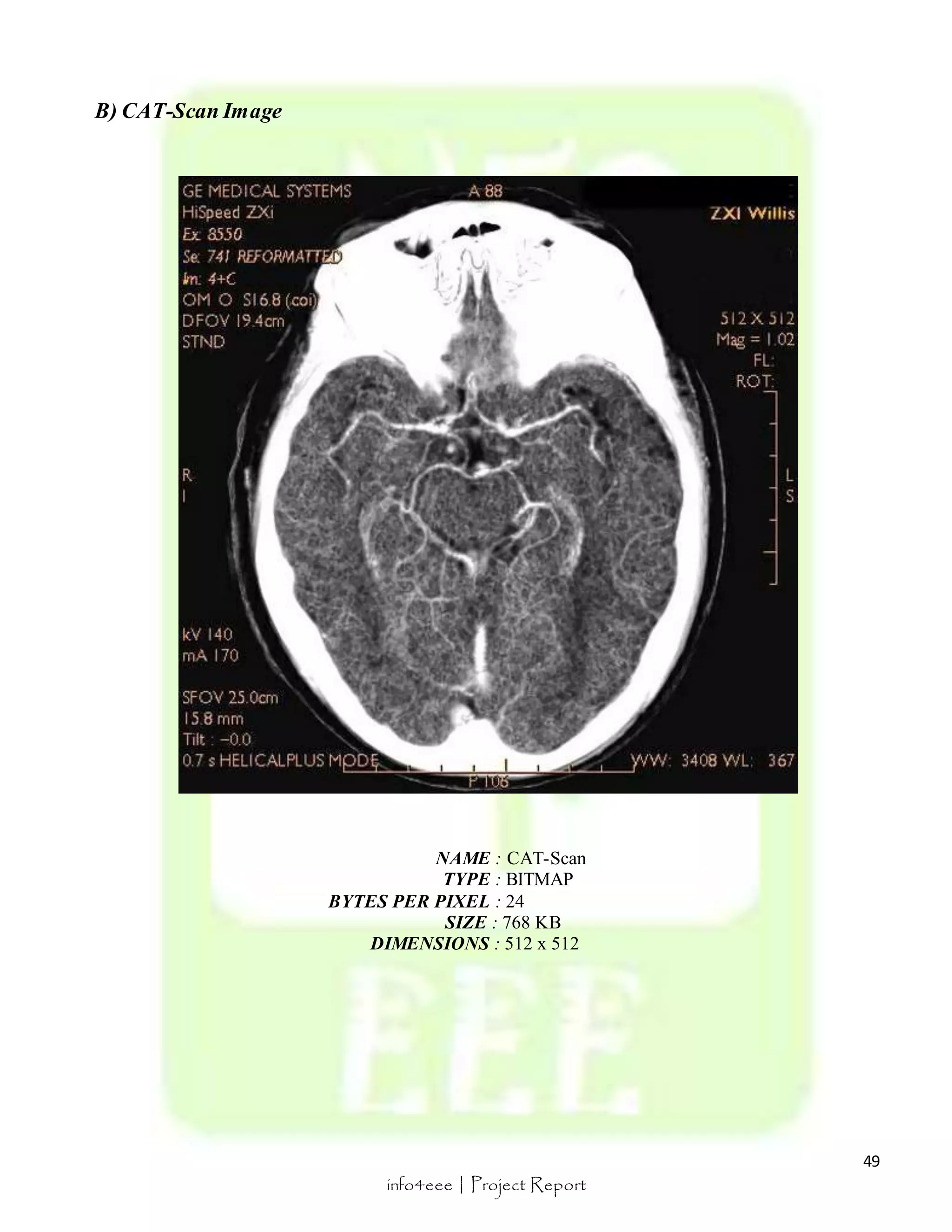 49 
info4eee | Project Report 
B) CAT-Scan Image 
NAME : CAT-Scan 
TYPE : BITMAP 
BYTES PER PIXEL : 24 
SIZE : 768 KB 
DIMENSIONS : 512 x 512 
 