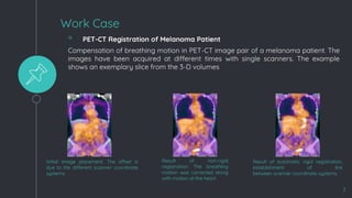 Ct Scan Registration Example Medical image registration ppt.potx