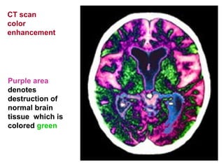Purple area
denotes
destruction of
normal brain
tissue which is
colored green
CT scan
color
enhancement
 