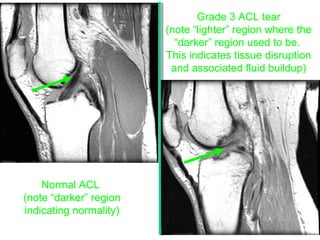 Normal ACL
(note “darker” region
indicating normality)
Grade 3 ACL tear
(note “lighter” region where the
“darker” region used to be.
This indicates tissue disruption
and associated fluid buildup)
 
