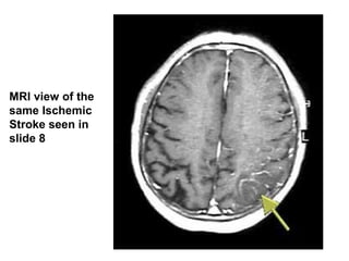 MRI view of the
same Ischemic
Stroke seen in
slide 8
 