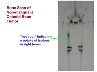 Bone Scan of
Non-malignant
Osteoid Bone
Tumor
“hot spot” indicating
u uptake of isotope
in right femur
 