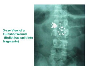 X-ray View of a
Gunshot Wound
(Bullet has split into
fragments)
 