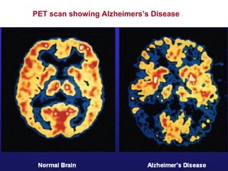 PET scan showing Alzheimers’s Disease
 