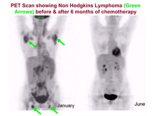 PET Scan showing Non Hodgkins Lymphoma (Green
Arrows) before & after 6 months of chemotherapy
 