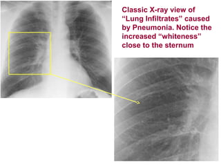 Classic X-ray view of
“Lung Infiltrates” caused
by Pneumonia. Notice the
increased “whiteness”
close to the sternum
 