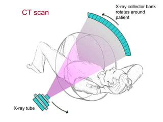 X-ray collector bank
rotates around
patient
X-ray tube
CT scan
 