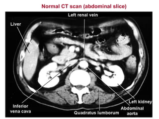Normal CT scan (abdominal slice)
 