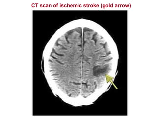 CT scan of ischemic stroke (gold arrow)
 