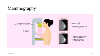 Mammography
05-03-2023 34
 