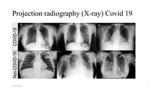 Projection radiography (X-ray) Covid 19
05-03-2023 7
 