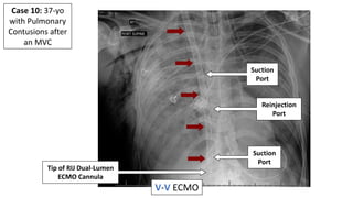 Medical Device Imaging Mastery Project #4: Extracorporeal Membrane Oxygenation