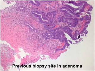 Previous biopsy site in adenoma
 