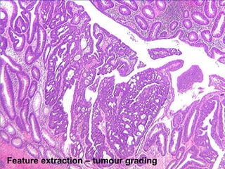Feature extraction – tumour grading
 