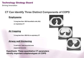Driving Innovation



   CT Can Identify Three Distinct Components of COPD
       Emphysema
             % lung less than -950 Hounsfield units (HU)
             on inspiratory CT




       Air trapping
             % lung less than -856 HU on expiratory CT



       Airway wall thickening
             % wall area / total bronchial area
             (segmental bronchi)

     Hypothesis: These quantitative CT parameters
     identify important subphenotypes of COPD
 