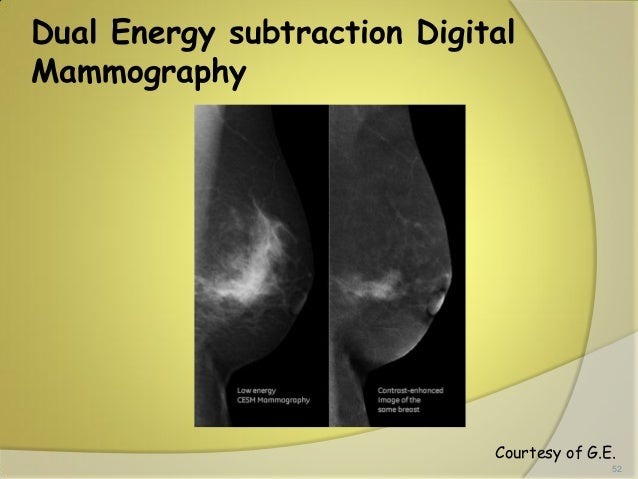 Digital breast imaging tomosynthesis and digital subtraction mammography
