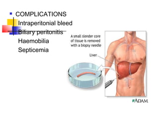  COMPLICATIONS
Intraperitonial bleed
Biliary peritonitis
Haemobilia
Septicemia
 